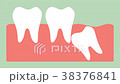 wisdom tooth ( angular or mesial impaction ) 38376841