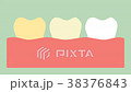 yellow to white tooth, teeth whitening 38376843