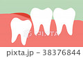 inflammation of wisdom tooth 38376844
