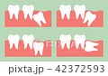 type of wisdom tooth 42372593