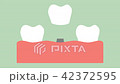 dental implant 42372595