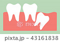 wisdom tooth ( distal impaction ) 43161838