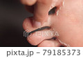 female feet during an acid peeling procedure.skin renewal and regeneration. skin restoration. foot care. health and hygiene. Tear off pieces of skin with your hands. 79185373