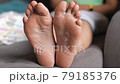 female feet during an acid peeling procedure.skin renewal and regeneration. skin restoration. foot care. health and hygiene. 79185376