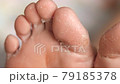 female feet during an acid peeling procedure.skin renewal and regeneration. skin restoration. foot care. health and hygiene. 79185378