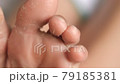 female feet during an acid peeling procedure.skin renewal and regeneration. skin restoration. foot care. health and hygiene. 79185381