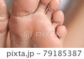 female feet during an acid peeling procedure.skin renewal and regeneration. skin restoration. foot care. health and hygiene. 79185387