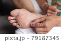 female feet during an acid peeling procedure.skin renewal and regeneration. skin restoration. foot care. health and hygiene. Tear off pieces of skin with your hands. 79187345