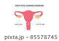 Polycystic ovarian syndrome 2D animation. Uterus, infertility, gynecology. For topics like pcos, disease, pelvic floor 85578745