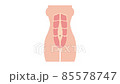 Formation of diastasis recti from normal toned abdomen muscles, also known as abdominal separation, common among pregnant women 85578747