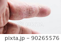 index finger skin disease on white background 90265576
