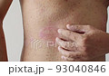 Psoriasis is the abdomen on white background. 4K Slow Motion 93040846