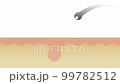 ムダ毛が抜けてきれいになる脱毛のアニメーション 99782512