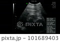 妊娠中の胎児の3Dエコー動画　超音波検査 101689403