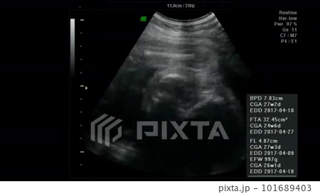 妊娠中の胎児の3Dエコー動画　超音波検査の動画素材 [101689403]