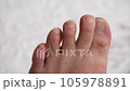 close-up elongated toenails,male foot in need of care,	 105978891
