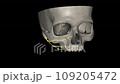 The zygomatic nerve is a branch of the maxillary nerve It arises in the pterygopalatine fossa and enters the orbit through the inferior orbital fissure 109205472