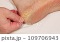 Cracked heel, rough skin on the foot. Man touches the cracking and peeling of the skin on the heels feet. Skin problem. Dermatology disease. Feet require medical care, pedicure. Close-up. 4k video 109706943