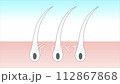 白髮 白髮是如何發生的 頭皮橫截面視頻 112867868