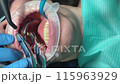 dentistry. intraoral welding of cobalt-chromium alloy beams in the patient's oral cavity.Vertical video 115963929