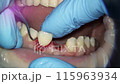 dentistry. removal of excess cement after fixation of ceramic restoration, veneer, crown 115963934
