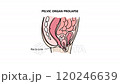 PELVIC ORGAN PROLAPSE Of Women Animated Diagram With Explanatory Text For Students Of Medical Schools Anatomical Education 120246639