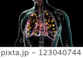 Lung histoplasmosis, 3D animation showing fungal infection caused by Histoplasma capsulatum, highlighting lung tissue damage and granulomas. 123040744
