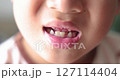 Close up of kid smiling with missing front tooth, child dental care, milk teeth falling out, childhood oral health, happy boy showing tooth gap, first lost tooth, growing up concept. 4K video. 127114404