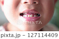 Close up of kid smiling with missing front tooth, child dental care, milk teeth falling out, childhood oral health, happy boy showing tooth gap, first lost tooth, growing up concept. 4K video. 127114409