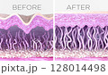 Skin layers cross-sectioned before and after anti-aging treatment. Fibroblast activation, collagen and elastin fiber regeneration, wrinkle reduction, and skin renewal  128014498