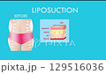 Mechanism of liposuction. Suction-assisted liposuction. Hollow tube or cannula, which is inserted through a small incision in the skin in order to fat suctioned out of the body. 3D animation 129516036