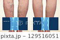 Varicose veins on a female senior legs. The structure of normal and varicose veins. Concept of dry skin, old senior people, varicose veins and deep vein thrombosis or DVT - 2D animation 129516051
