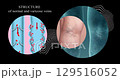 Varicose veins on a female senior legs. The structure of normal and varicose veins. Concept of dry skin, old senior people, varicose veins and deep vein thrombosis or DVT - 2D animation 129516052