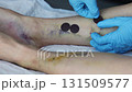 Doctor applies the stick on bandage to cover the small cuts after operation. 131509577