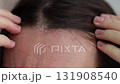 Woman with dandruff on her scalp, closeup. 4K, slow motion. 131908540
