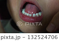 Loose baby teeth that are about to fall out and be replaced by permanent teeth 1 132524706
