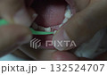 Loose baby teeth that are about to fall out and be replaced by permanent teeth 2 132524707