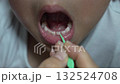 3 Loose baby teeth that are about to fall out and be replaced by permanent teeth 132524708