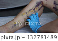 Doctor checking wounds some days after innovative method of varicose veins surgery, sclerotherapy procedure. Close-up shot of patient legs. 4K 132783489