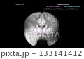 Healthy and Parkinsons Motor Pathway Comparison on Black Background 133141412