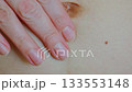 Close-up woman touching postpartum stretch marks on an adult female abdomen. Skin changes after childbirth 133553148
