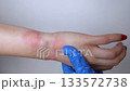 Close-up of a swollen wrist with visible redness, inflammation, and skin irritation caused by an insect bite or allergic reaction. The hand shows signs of rash, itching, and local pain, typical of mos 133572738