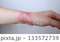 Close-up of a swollen wrist with visible redness, inflammation, and skin irritation caused by an insect bite or allergic reaction. The hand shows signs of rash, itching, and local pain, typical of mos 133572739