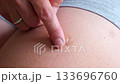Applying moisturizing gel to a bruise using light, circular motions 133696760