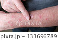 Caucasian man applies cream to inflamed and itchy insect bites on his arm 133696789