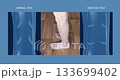 Varicose veins on a female senior legs. The structure of normal and varicose veins. Concept of dry skin, old senior people, varicose veins and deep vein thrombosis or DVT - 2D animation 133699402