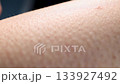 Goosebumps Appear as Skin Reacts to Cold and Other Stimuli During Certain Moments 133927492