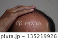 薄毛の頭を撫でる男性の頭（日本人、30代） 135219926