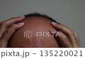 薄毛の頭を押さえて絶望する男性の頭（日本人、30代、顔無し） 135220021