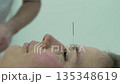 Acupuncture, woman, face receiving therapeutic needle treatment during a holistic alternative medicine session. 135348619